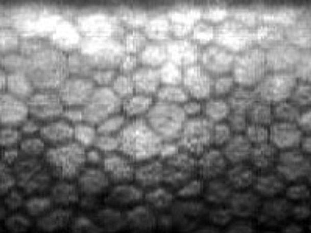 減少した角膜内皮細胞